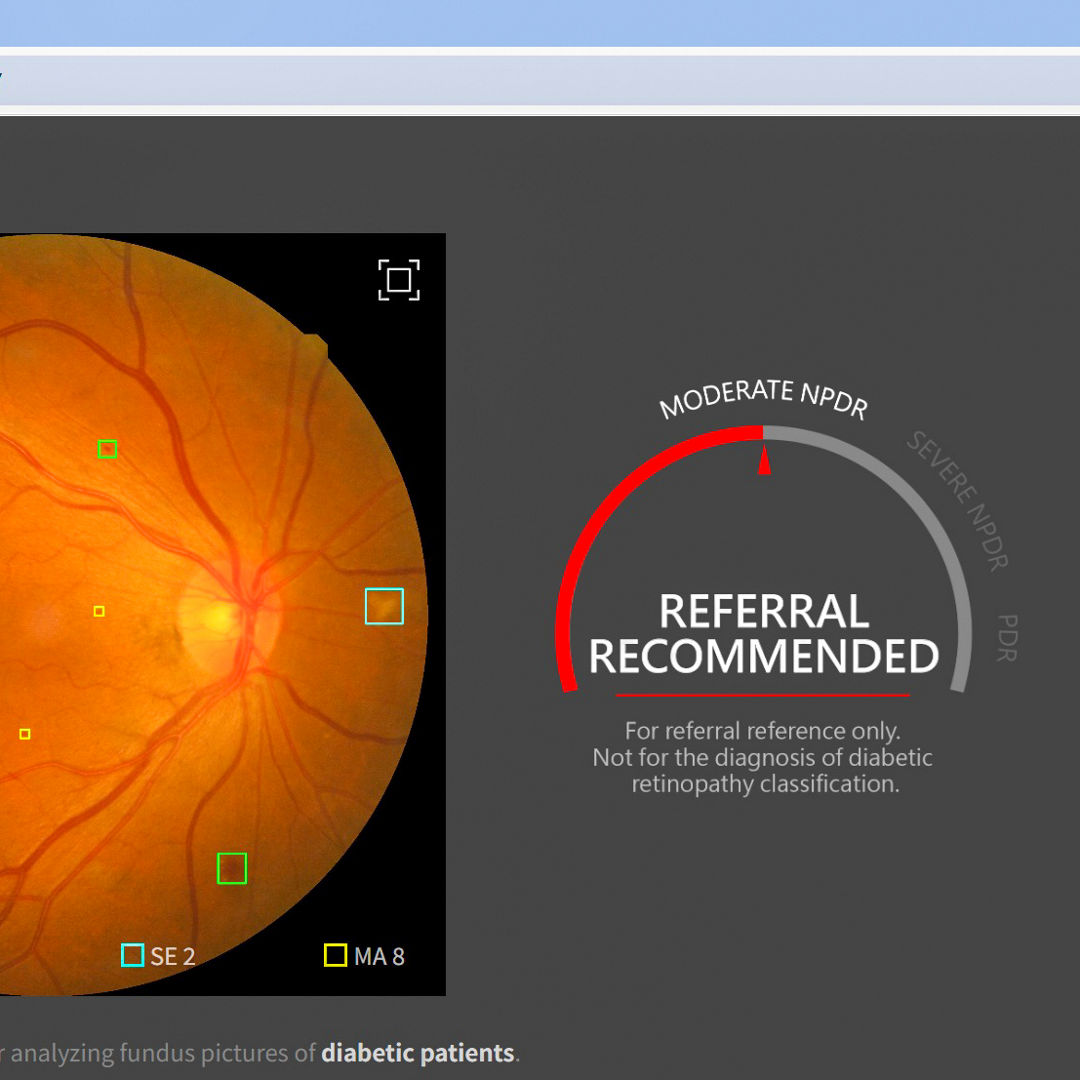 Screenshot of VeriSee DR software showing an eye scan with a 'Referral Recommended' result.