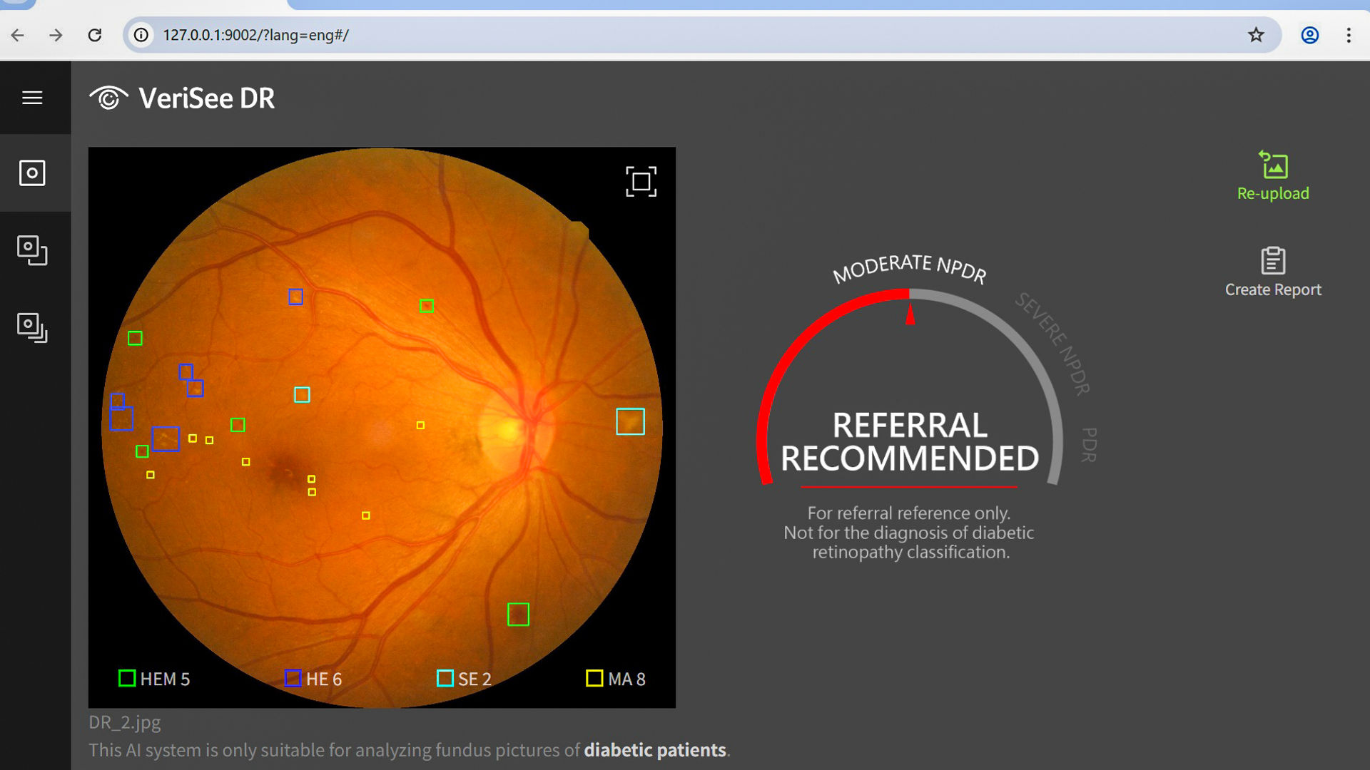 A screen capture shows the Acer Medical VeriSee DR solution. It detects abnormalities and complications in eye scans in 10 seconds, providing classification of severity and recommendations for further actions, such as referring patients to specialists. (Credit: Acer Medical Inc.)