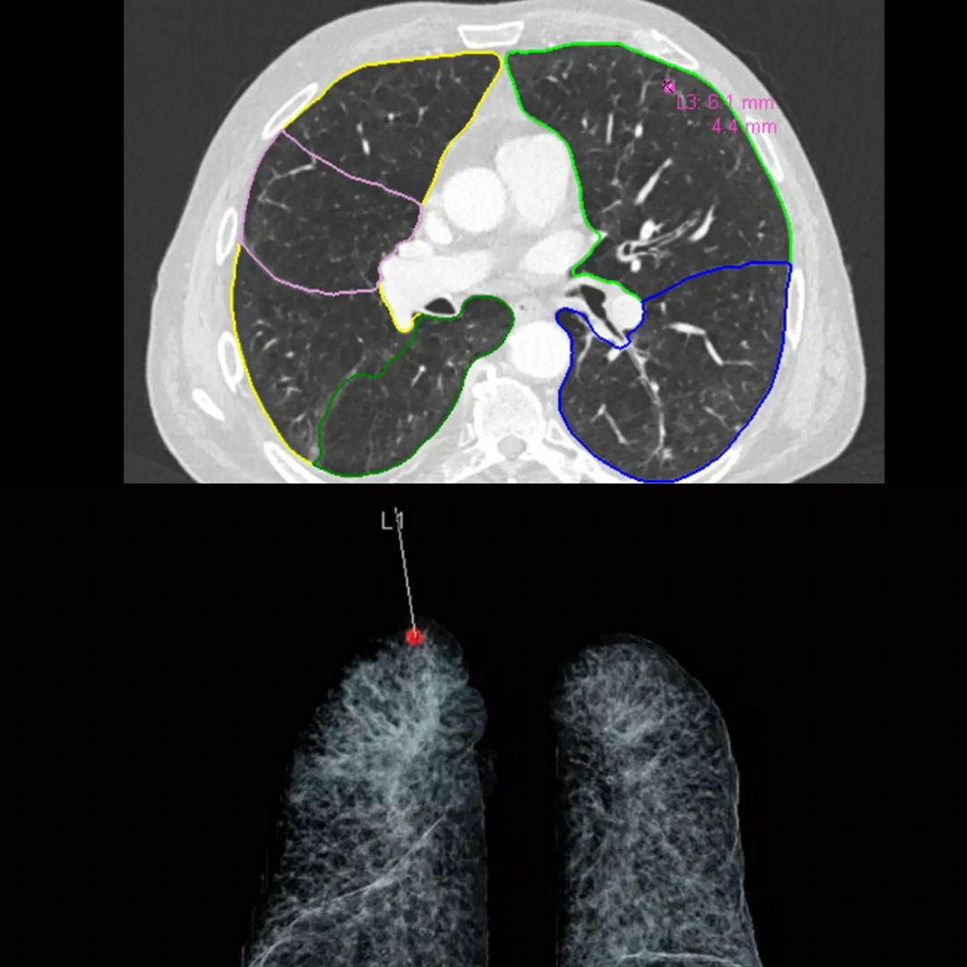 AI-assisted CT scans of lungs showing color-coded nodule segmentation and a red marker for location.