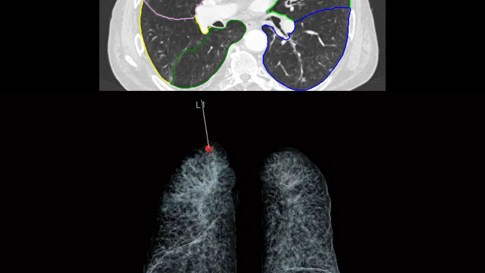 AI-assisted CT scans of lungs showing color-coded nodule segmentation and a red marker for location.