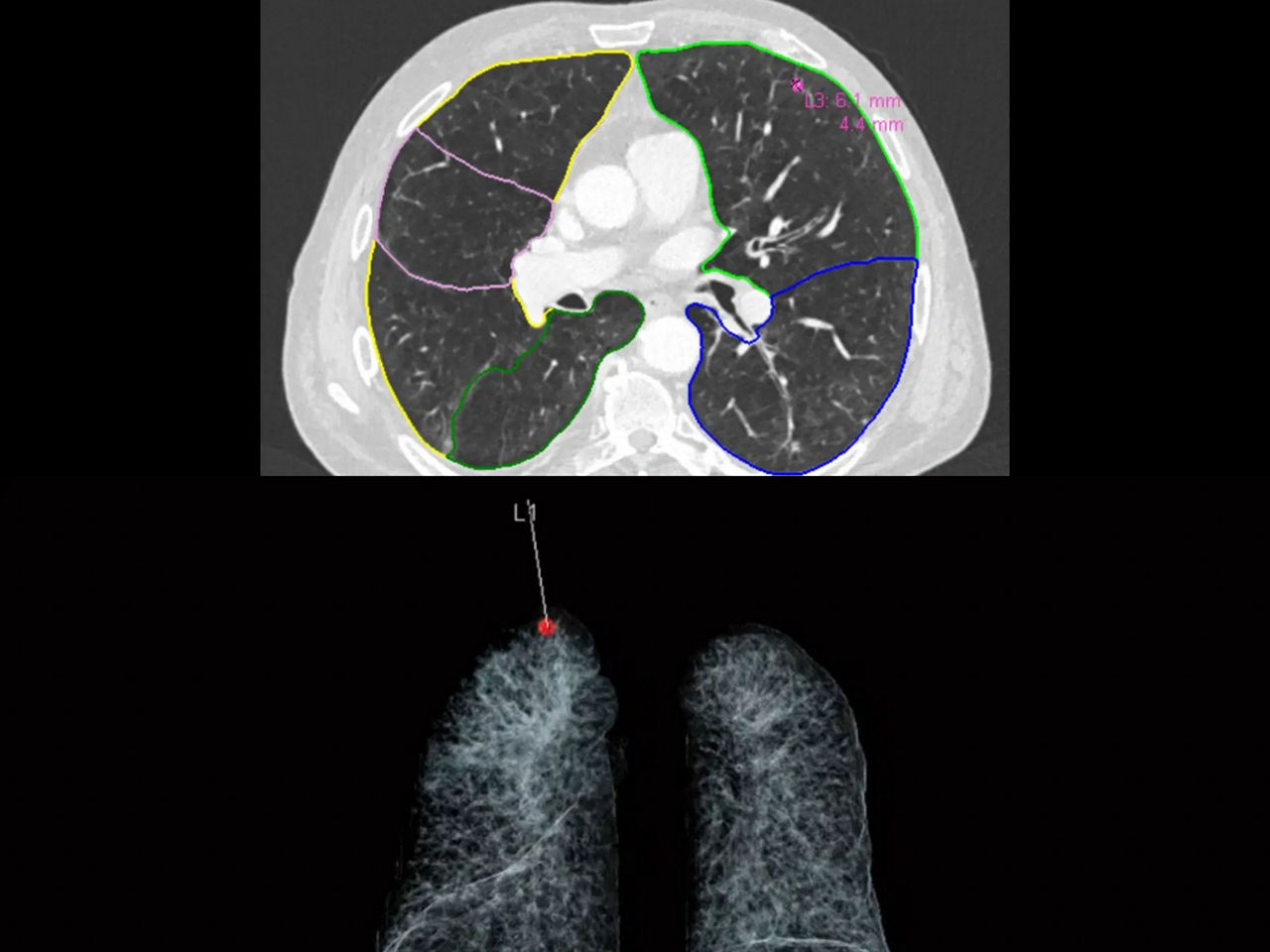 Two images show AI scans of lungs. In the top image, Siemens Healthineers’ AI-Rad Companion Chest CT detects and highlights abnormal lung nodules. After color-coded segmentation of the lung nodules, the volume, diameters and tumor burden are calculated. In the bottom image, the location of a detected lung nodule is marked with the red dot. This makes it easy for the physician to get a clear picture of the nodule location within the lung. (Credit: Siemens Healthineers via Klinikum Nürnberg, Nuremberg, Germany)