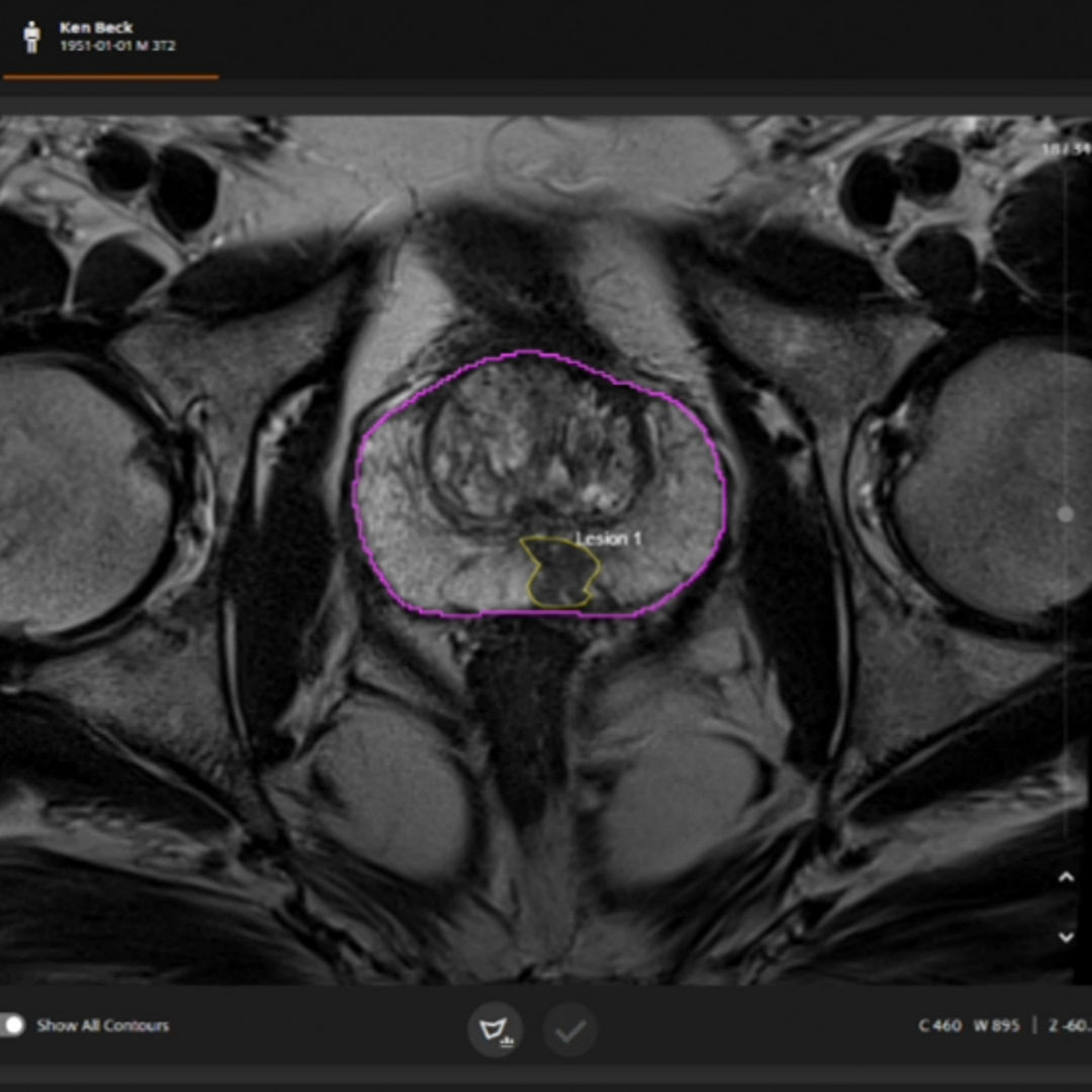 Prostate MR scan in AI-Rad Companion showing a purple prostate outline and yellow lesion contour.