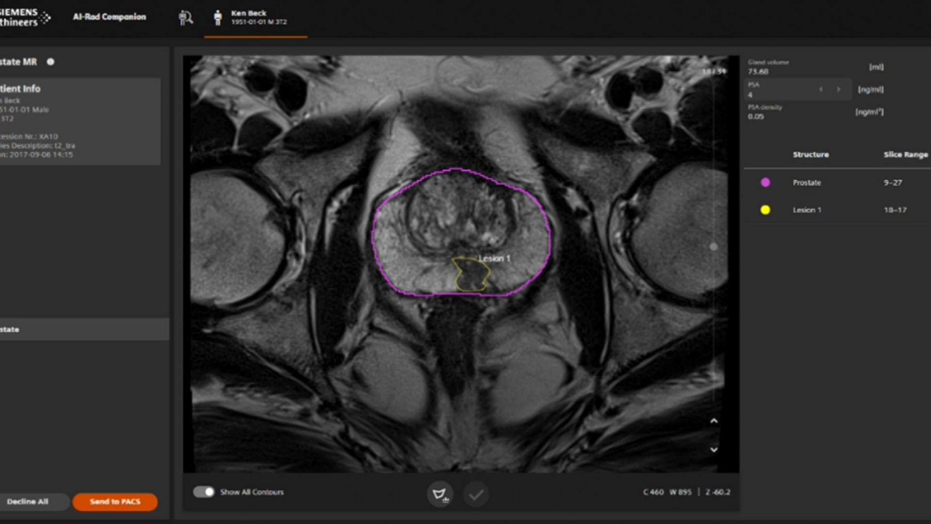 Prostate MR scan in AI-Rad Companion showing a purple prostate outline and yellow lesion contour.