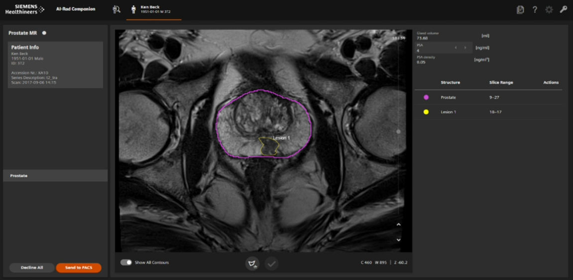 An image shows an AI scan of a prostate. The AI-Rad Companion Prostate MR performs an automated segmentation of the prostate to differentiate it from other organs. The radiologist manually marks and characterizes lesions and other targets the AI has found. In this image, the purple line identifies the prostate while the yellow line contours an abnormality, or lesion, that could be cancerous. (Credit: Siemens Healthineers via Clinica Universidad de Navarra, Spain)