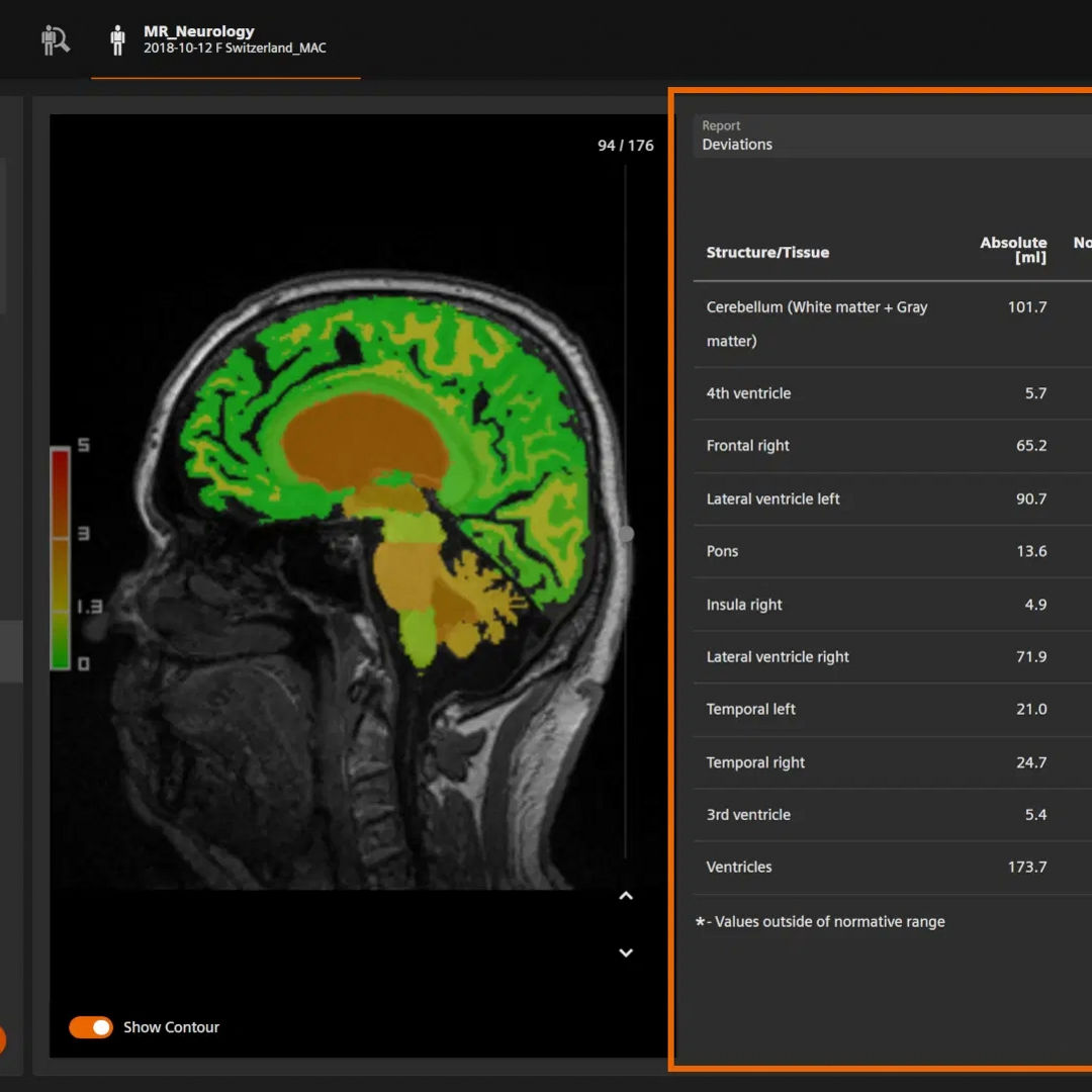AI-Rad Companion interface showing a segmented brain MRI and a report of volumetric deviations.