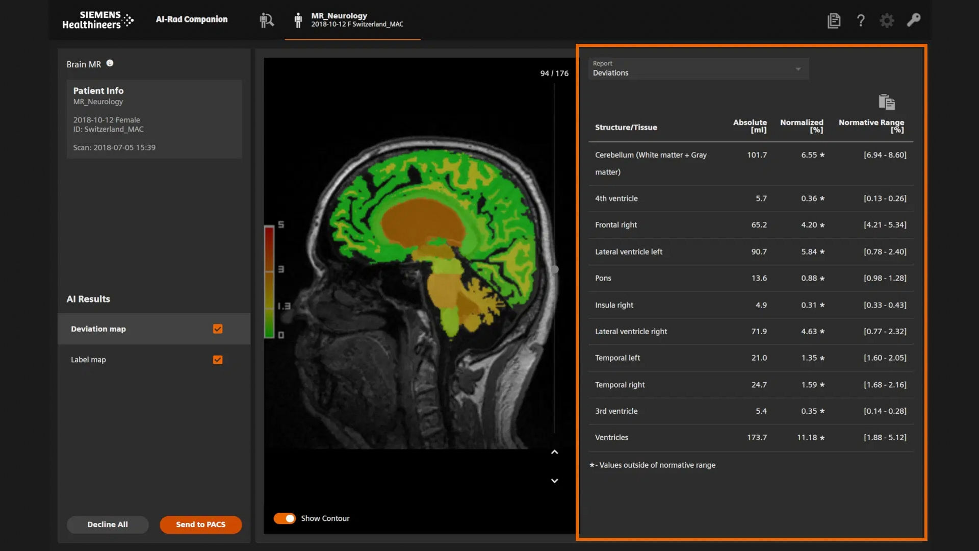 AI-Rad Companion interface showing a segmented brain MRI and a report of volumetric deviations.