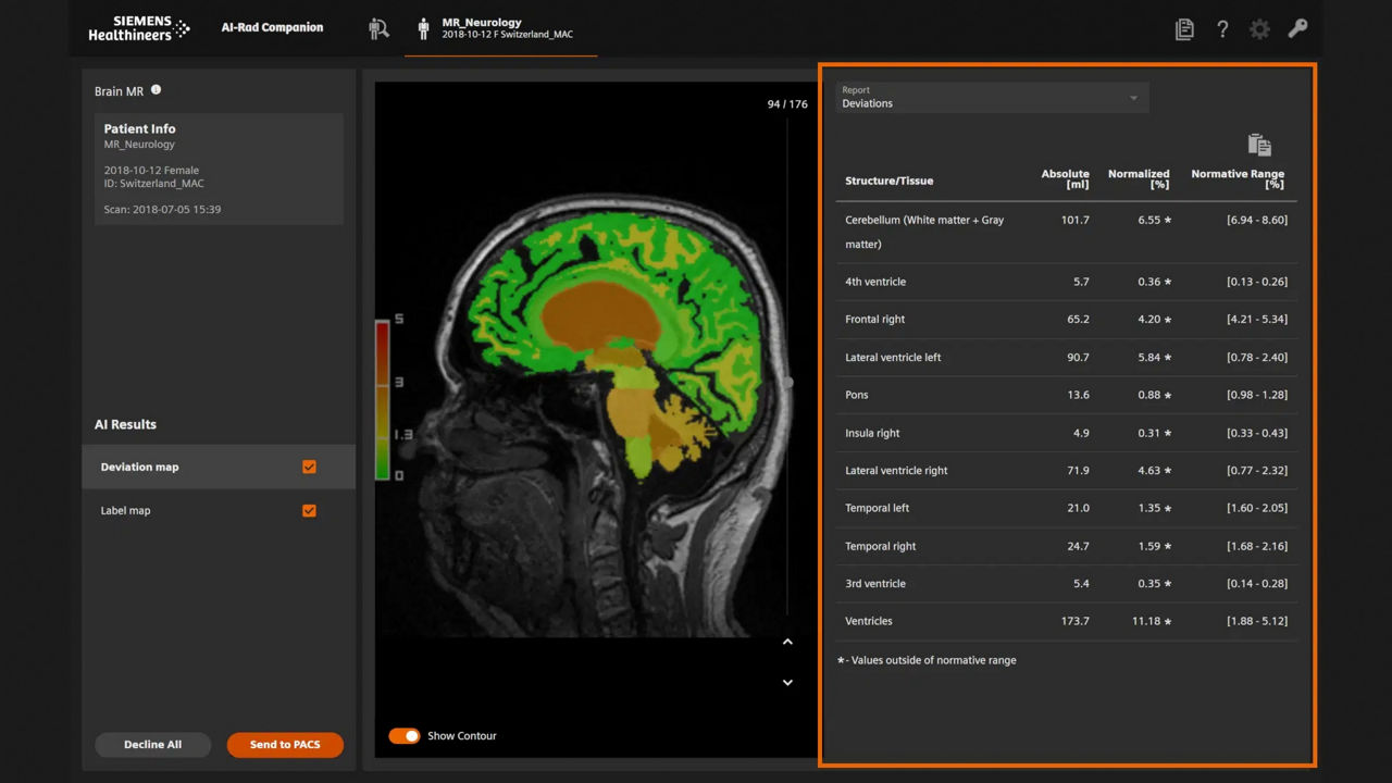An image shows an AI scan of a brain. AI-Rad Companion segments out the different brain structures using colors and provides volumetric analysis of each. It then compares the volumes to a normative database and generates a list of the abnormalities or deviations to alert clinicians. (Credit: Siemens Healthineers via Centre d’imagerie diagnostique, Lausanne, Switzerland)