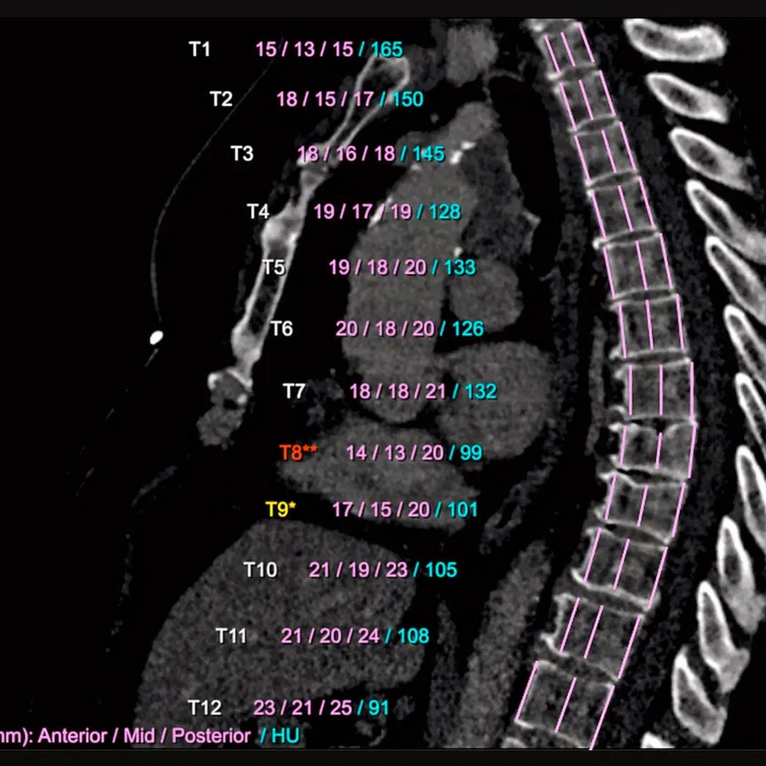 An image shows an AI scan of a spinal column. The height of each vertebra is measured and compared. Siemens Healthineers’ AI-Rad Companion Chest CT automatically processes these measurements and marks abnormalities with easy-to-understand color-coding. Deviations are highlighted in red and yellow, and bone density is reported. (Credit: Siemens Healthineers via Klinikum Nürnberg, Nuremberg, Germany)